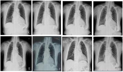 The Effect of Sacubitril/Valsartan Treatment on Cardiac and Renal Functions of a Patient With Cardiorenal Syndrome Type 4 and Stage 5 CKD After More Than Three Years of Follow-Up